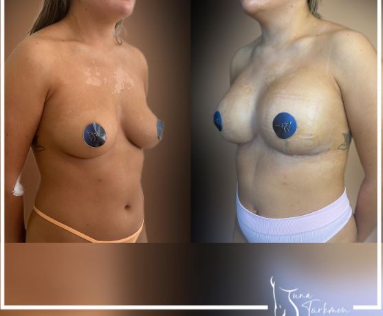 breast-lift-with-implant-1